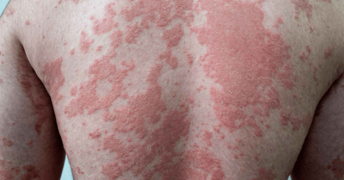 psoriasis