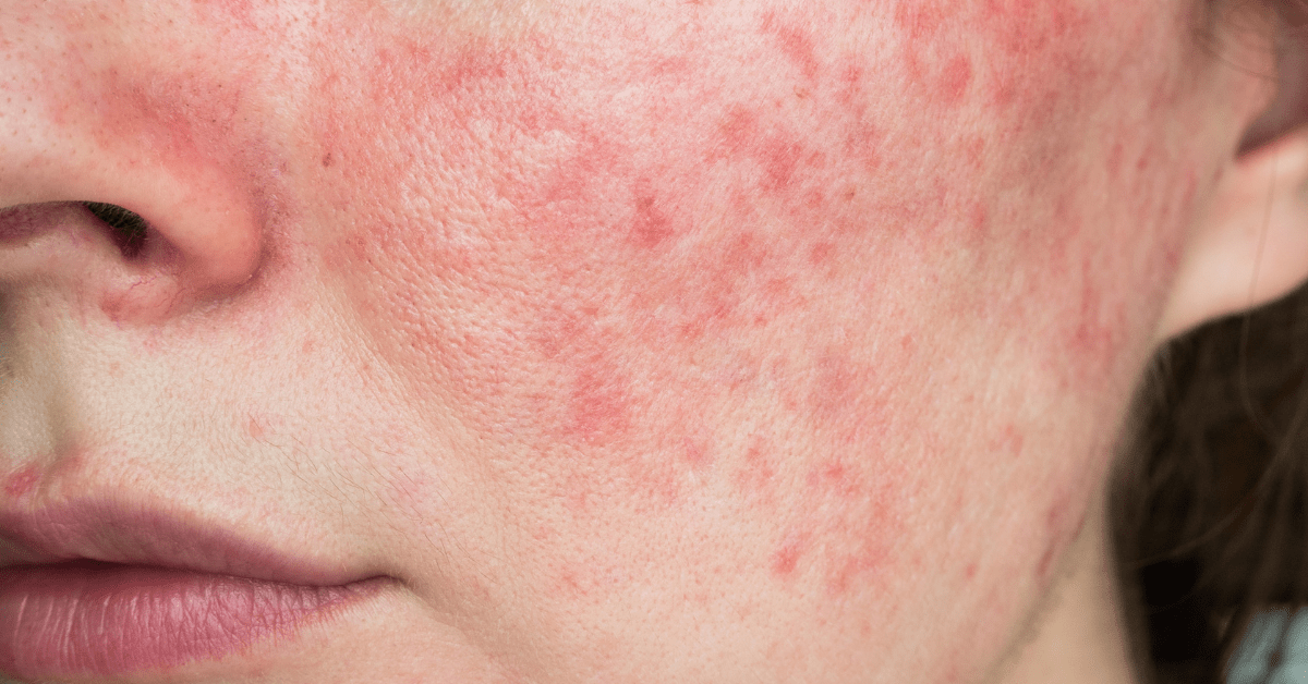 Rosacea