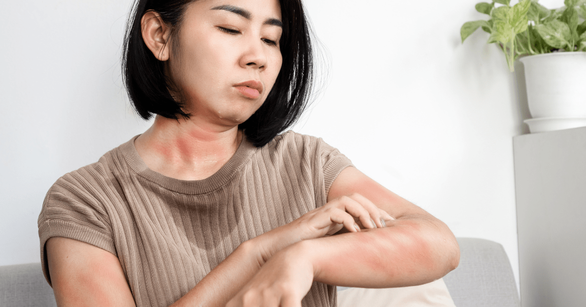 eczema-prone skin