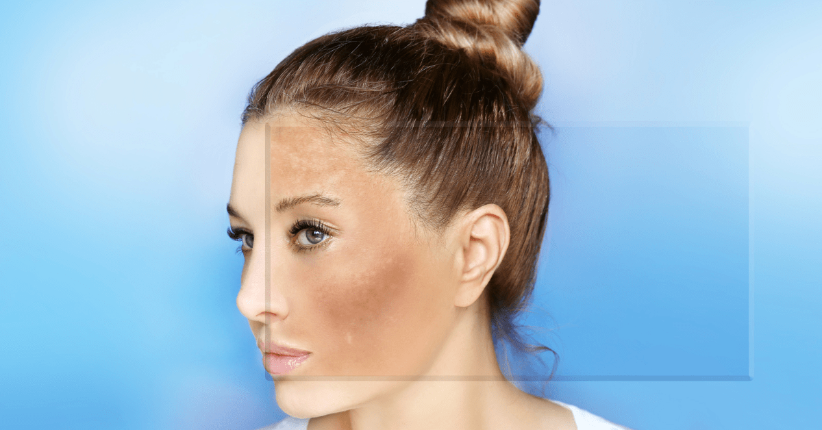 Hyperpigmentation