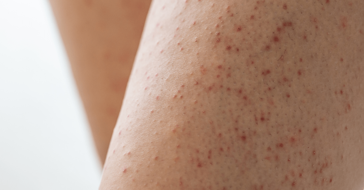 Keratosis pilaris