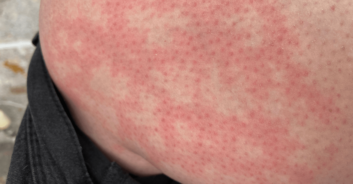 Post-Inflammatory Erythema