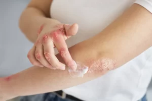  Prevent Psoriasis Skin Protection & Trigger Management Tips