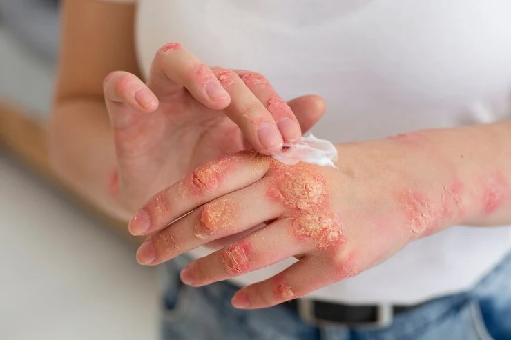 Prevent Psoriasis Skin Protection & Trigger Management Tips