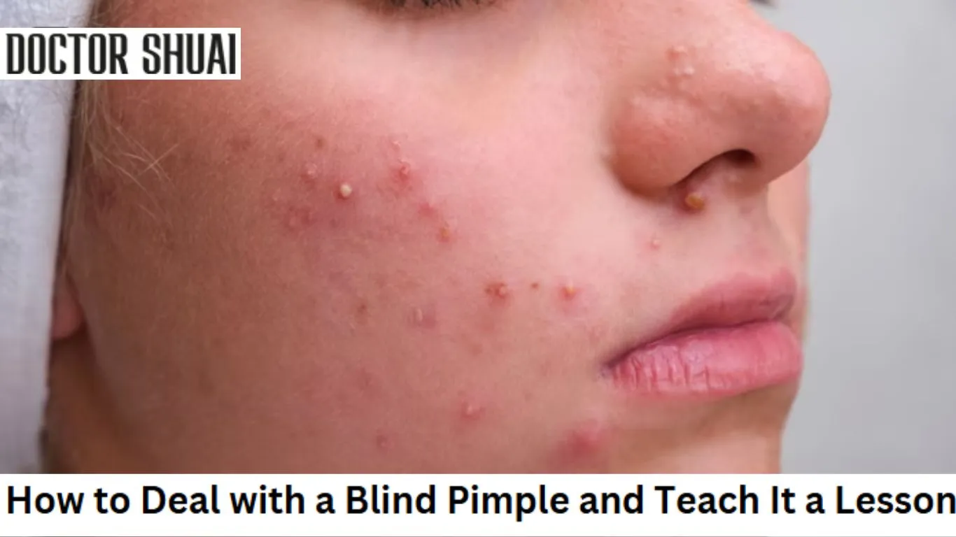 How to Deal with a Blind Pimple and Teach It a Lesson