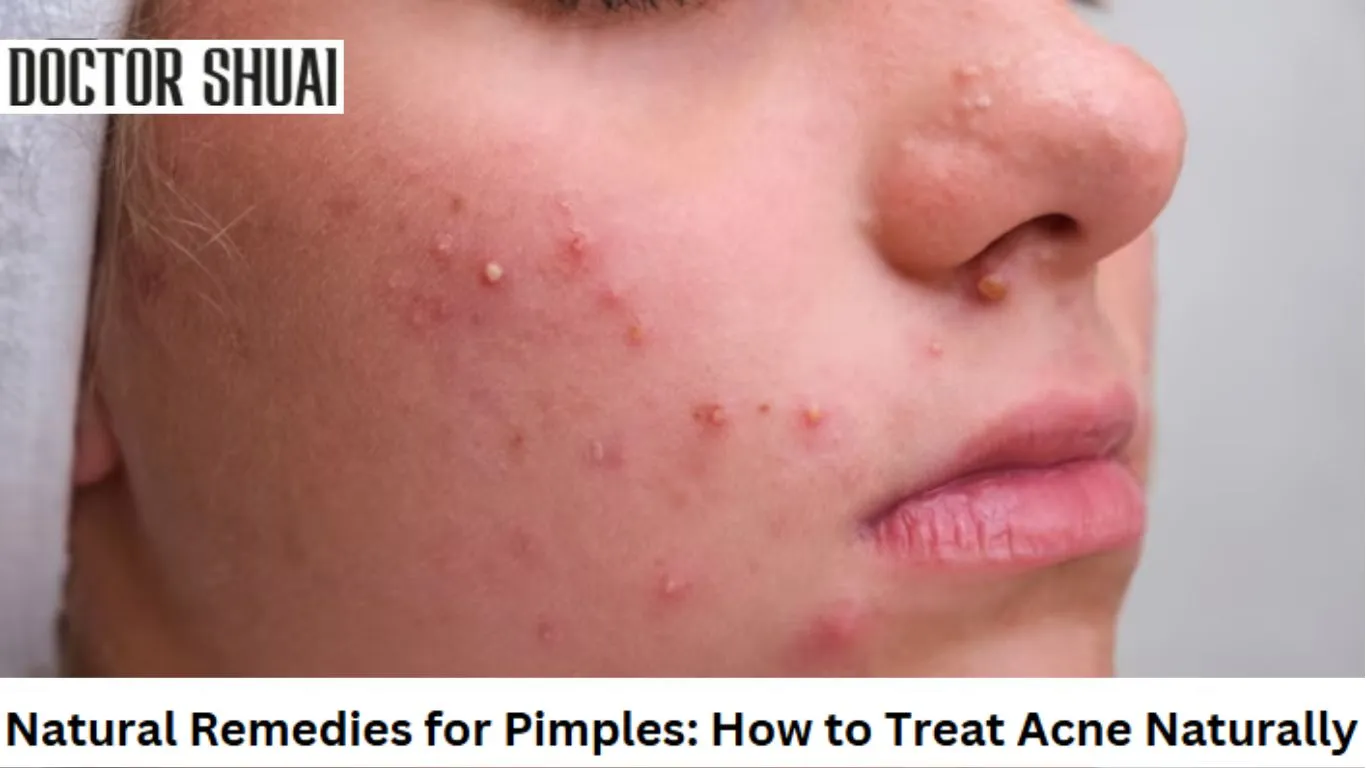 Natural Remedies for Pimples: How to Treat Acne Naturally