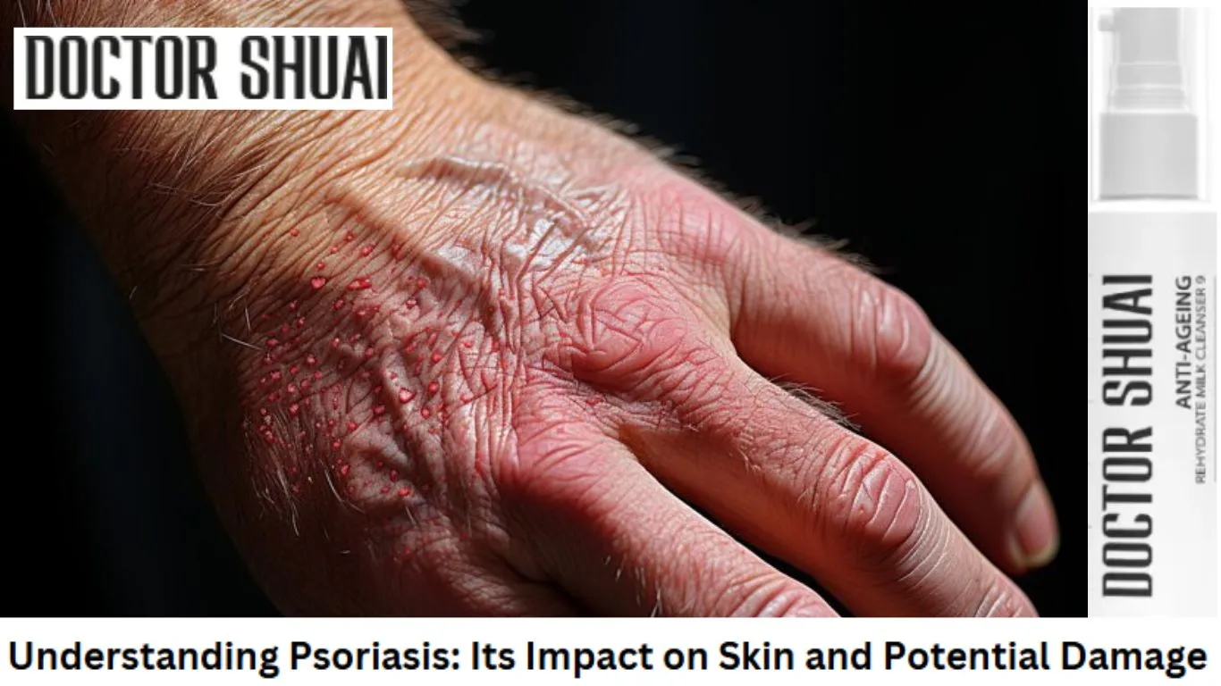 Understanding Psoriasis: Its Impact on Skin and Potential Damage