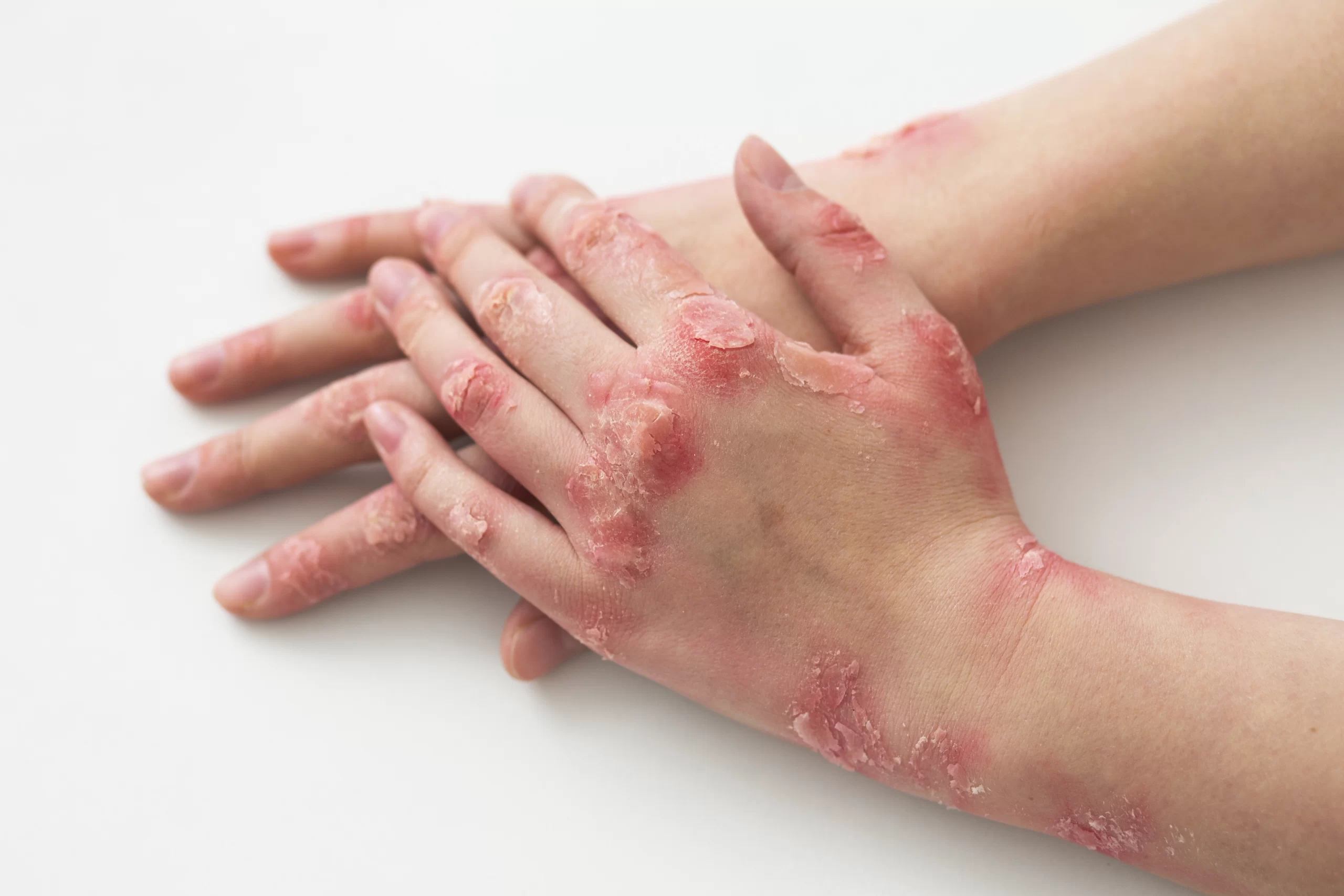 Eczema: Skin Impact & Precautions for Care